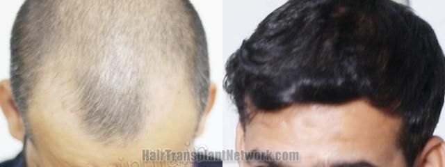 Top view - Before and after hair restoration results