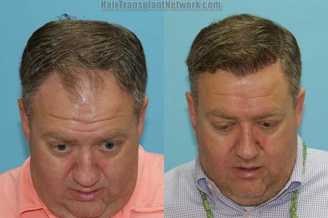 Before and after hair restoration procedure images