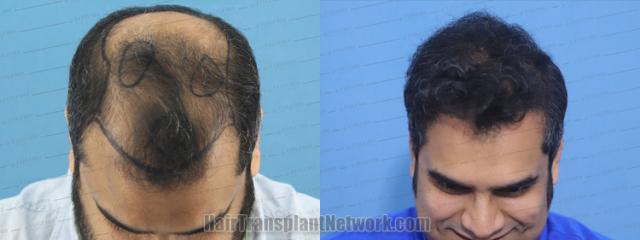  before and after result photographs