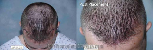 Hair transplantation surgery before and after photos