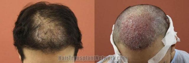 Hair restoration procedure before and after pictures