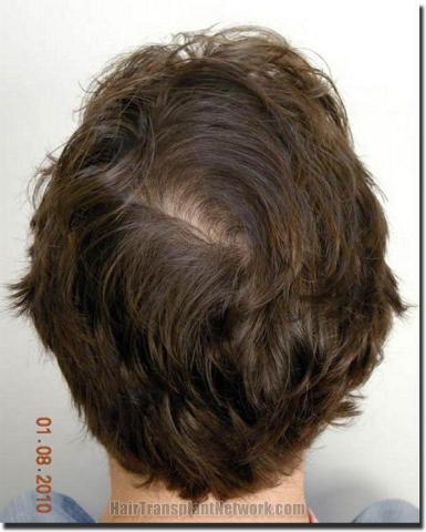 Hair restoration procedure results