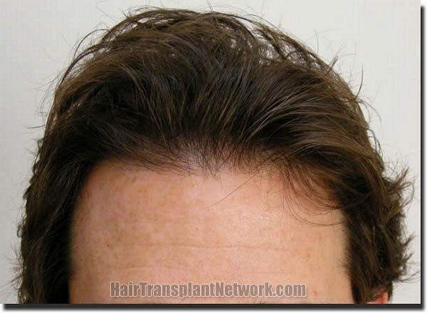 Hair restoration procedure results