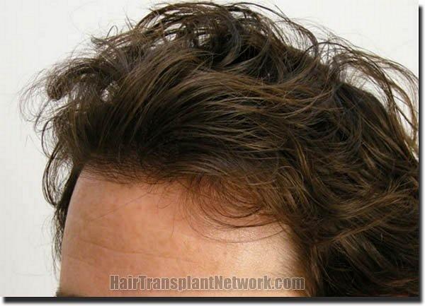 Hair restoration procedure results