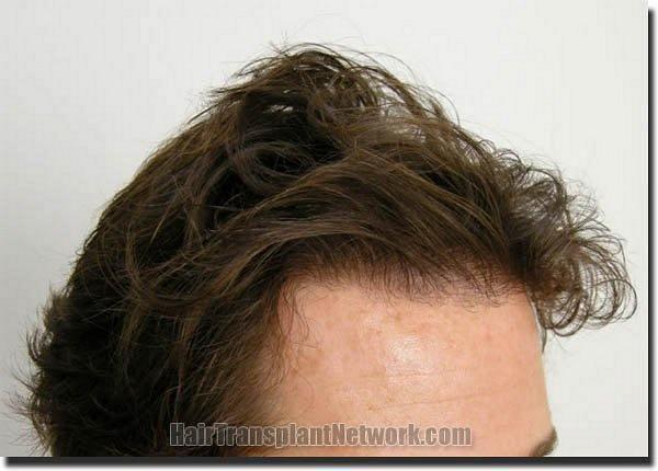 Hair restoration procedure results