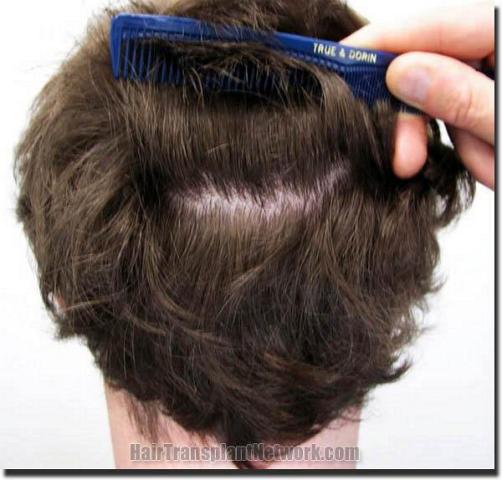 Hair restoration procedure results