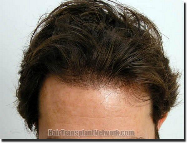 Hair restoration procedure results