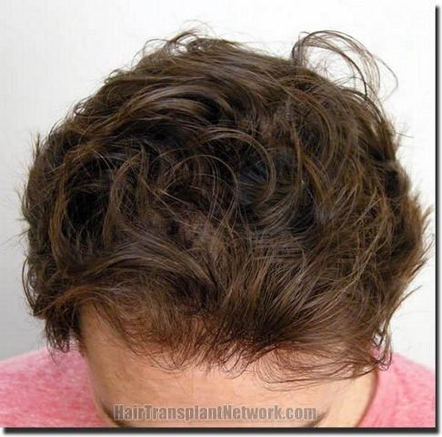 Hair restoration procedure results