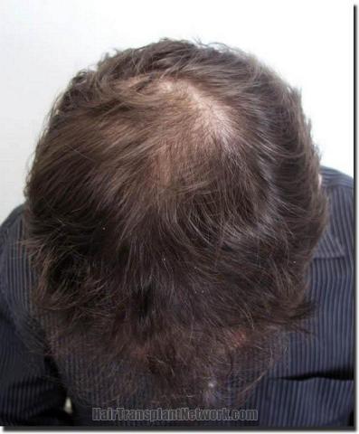 Hair restoration procedure results