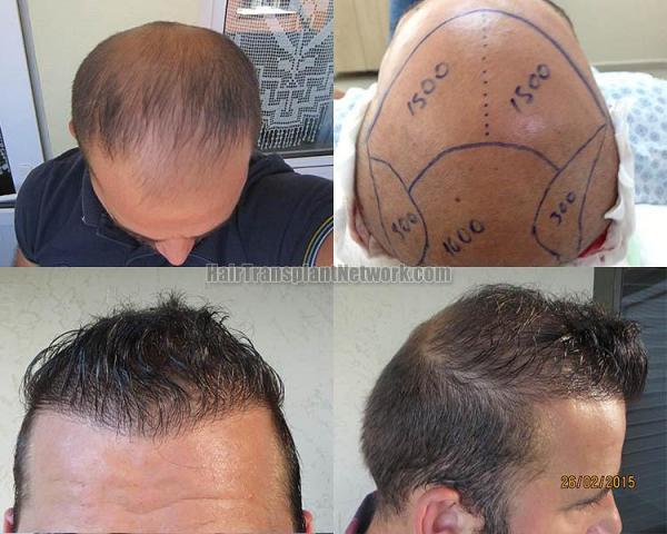 Hair transplant surgery before and after result photographs