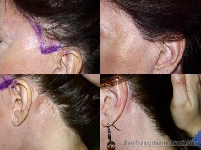 Left side view of woman's hair transplant before and after