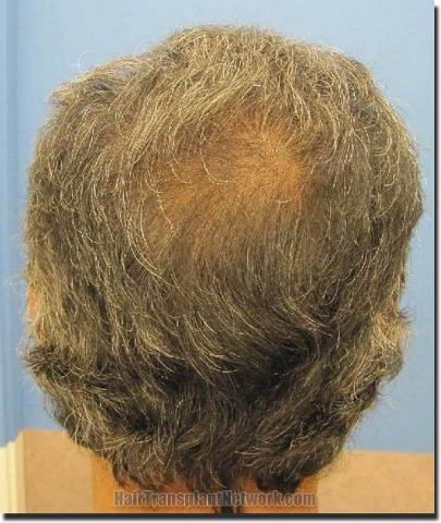 Hair restoration procedure results