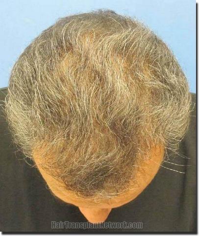 Hair restoration procedure results