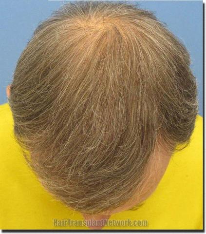 Hair restoration procedure results