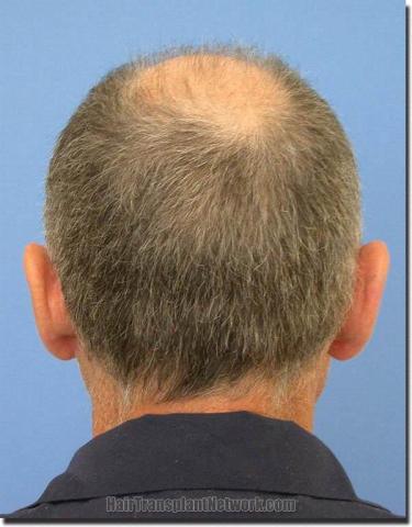 Hair restoration procedure results