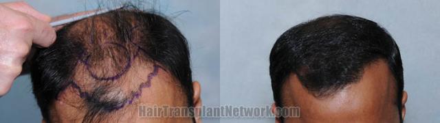Top view - Before and after hair restoration procedure