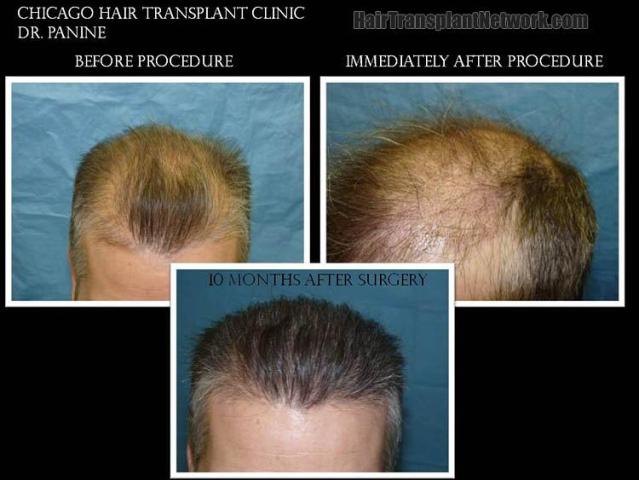 Hair transplantation surgery before and after images