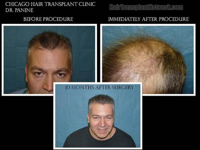 Hair restoration procedure before and after results