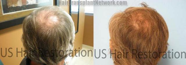 Back / Crown results from hair restoration operation