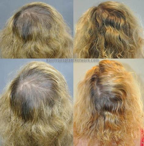 Surgical hair transplantation result photographs