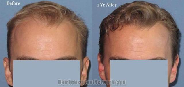 Front view - Before and after hair restoration surgery