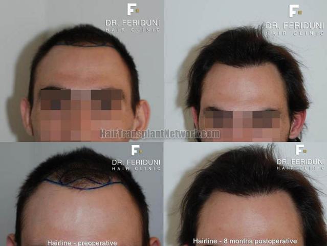 Dr Bijan Feriduni Hair Restoration Surgical Procedure Before And After