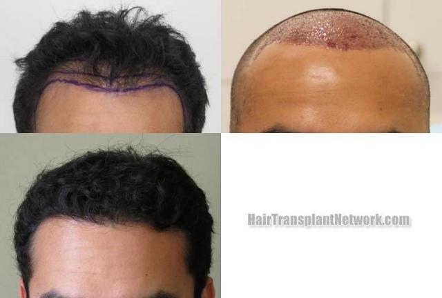 Hair restoration procedure before and after results