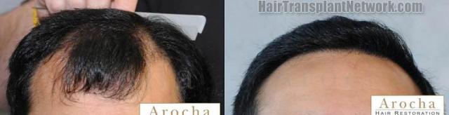 Before and after hair transplantation result photographs