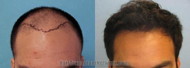 Hair restoration procedure before and after results