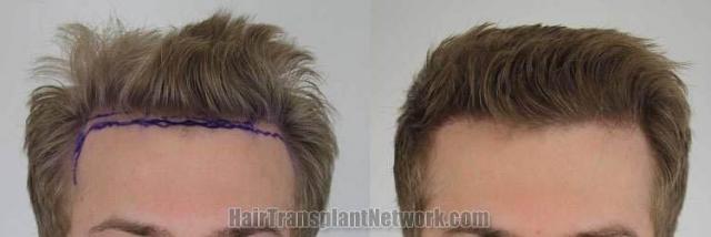 Hair restoration procedure before and after results