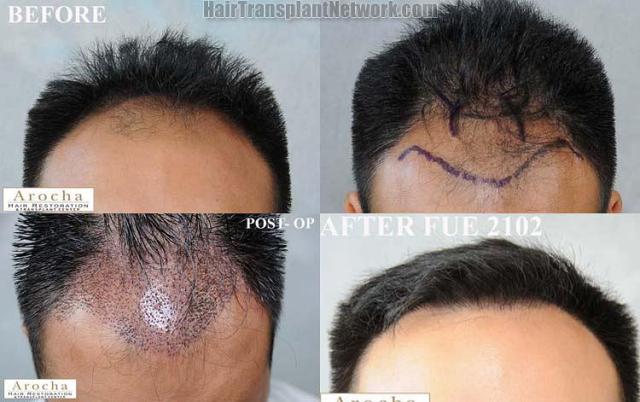 Hair restoration procedure before and after results