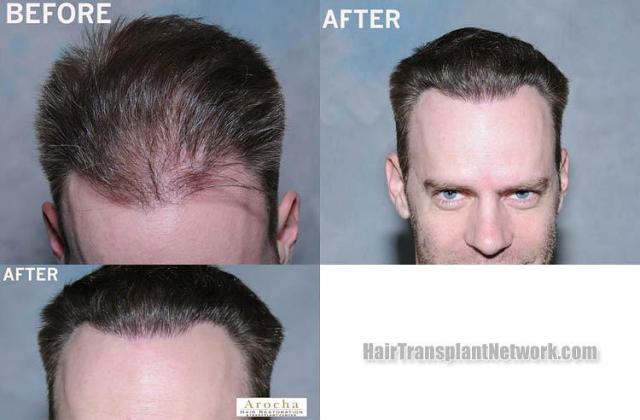 Hair restoration procedure before and after results