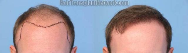 Front View - Before and after hair transplantation surgery