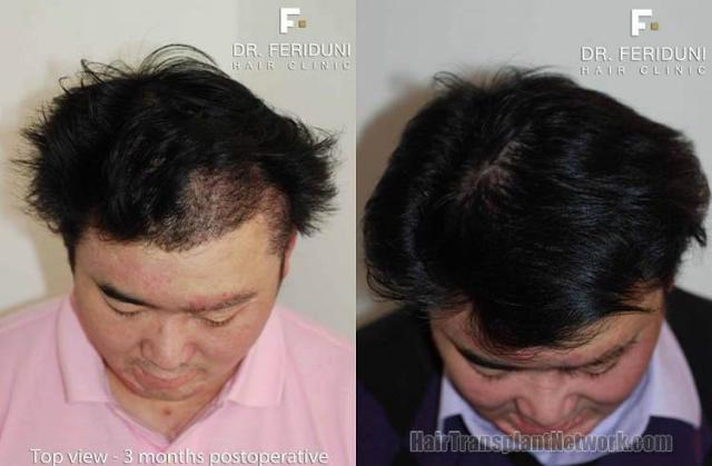 After hair transplant photos shown from the top