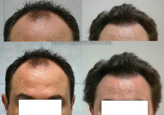 Front view - Before and after hair transplantation