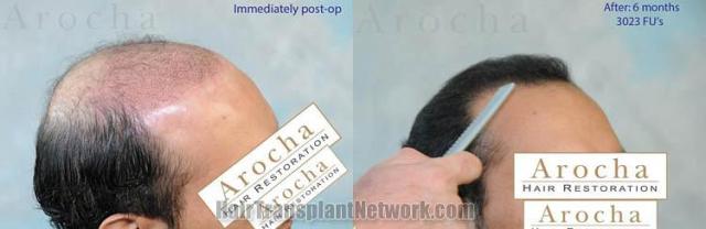 Hair transplantation surgery before and after images