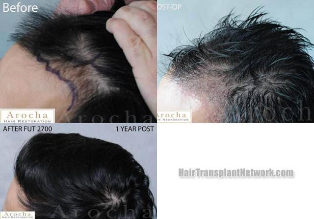 Hair transplantation surgery before and after pictures