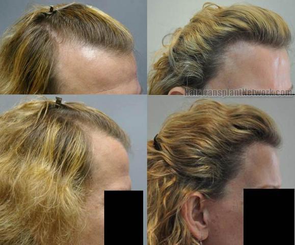 Hair transplantation surgery before and after photos