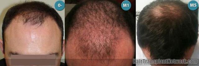 Before and after hair transplantation surgery