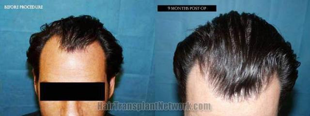 Top view before and after hair restoration results