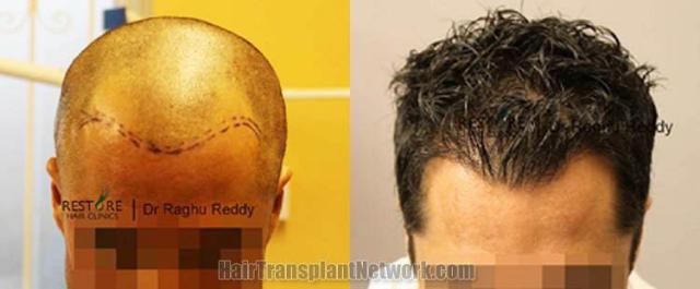 Hair transplantation surgery before and after photos