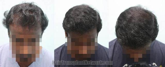 Hair transplantation surgery before and after photos,