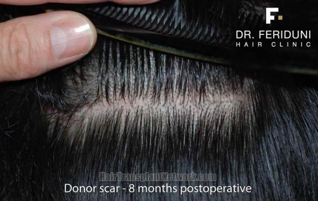 Residual donor scar 8 months after hair transplant