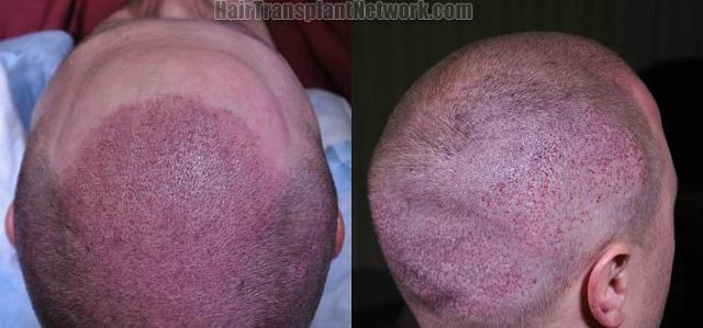 Hair transplant surgery before and after photos