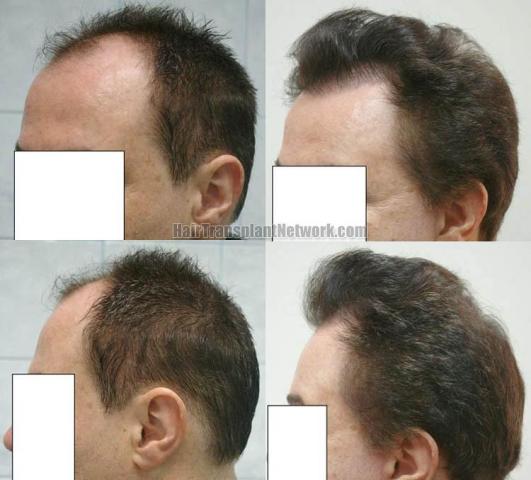 Left view - Before and after hair replacement surgery 