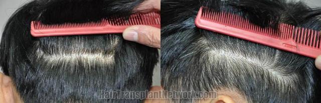 Hair restoration procedure residual scar images