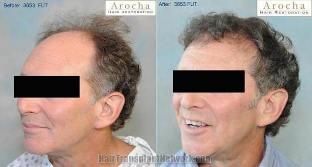 Before and after surgical hair restoration images