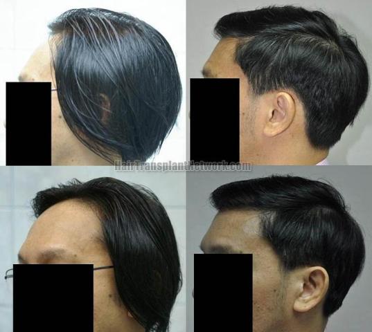 Before and after surgical hair restoration images