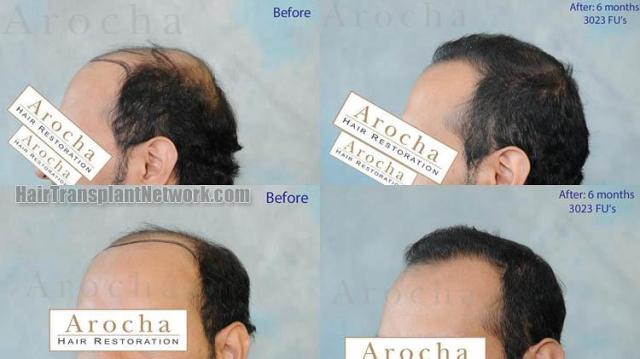 Hair transplantation surgery before and after pictures