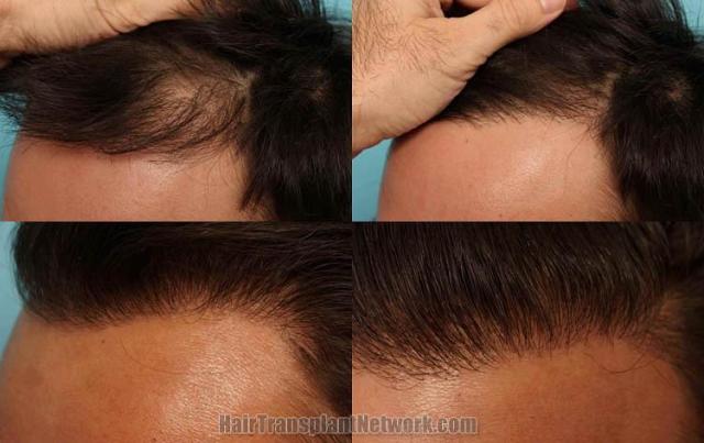 Hair transplantation surgery before and after pictures